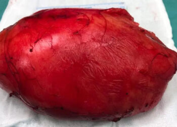 ابو ظہبی میں ہند نژاد مریض کے جسم سے 5 کلو وزنی کینسر کی رسولی نکال دی گئی